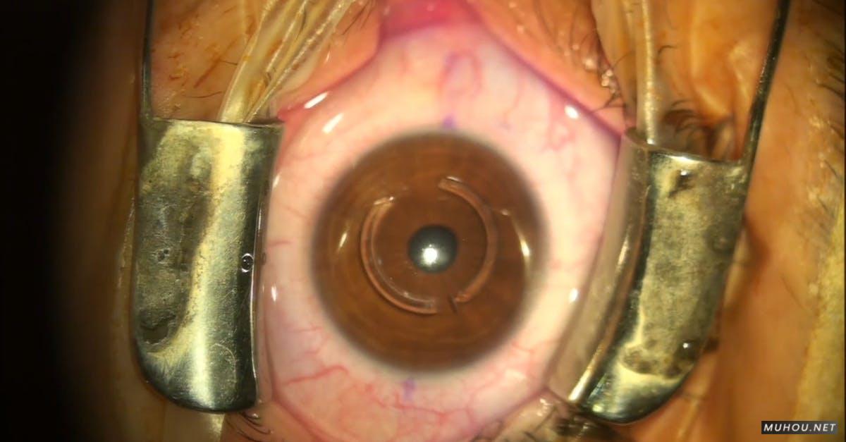 2061566| 近视眼手术眼球瞳孔特写CC0视频素材插图